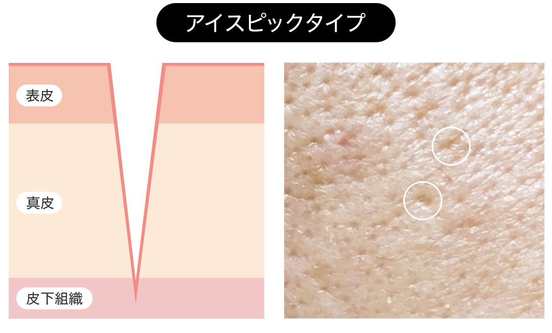 ニキビ跡の種類：アイスピック型