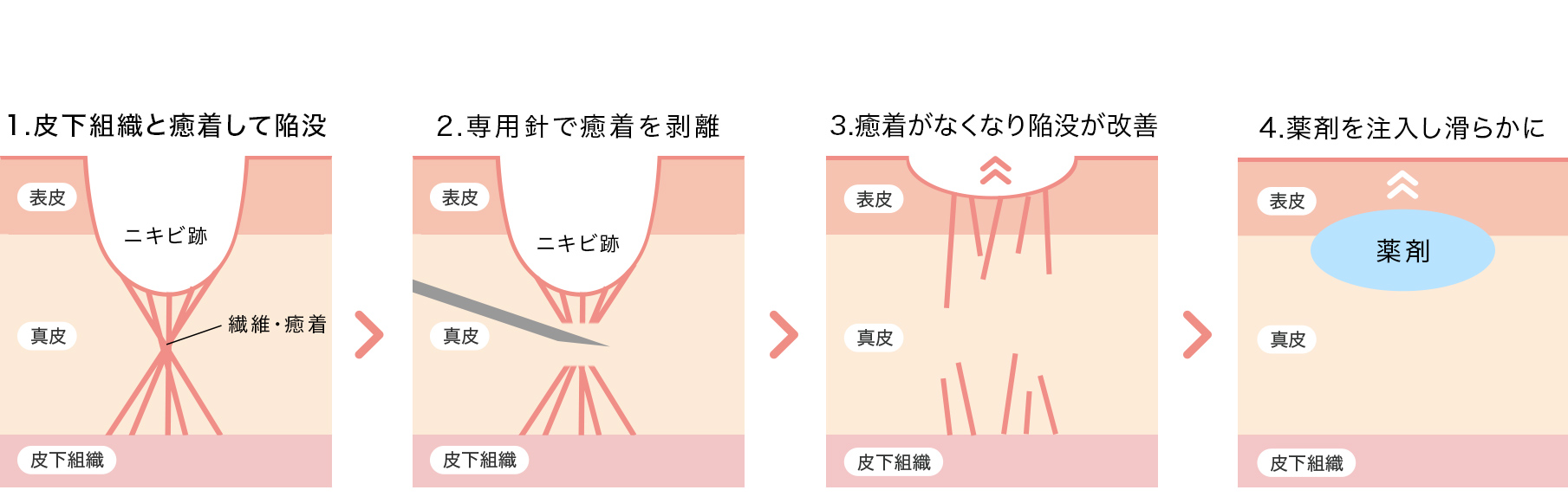 A式美肌サブシジョン